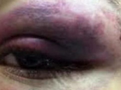 Grávida é espancada com barra de ferro por ex, perde bebê e é agredida novamente