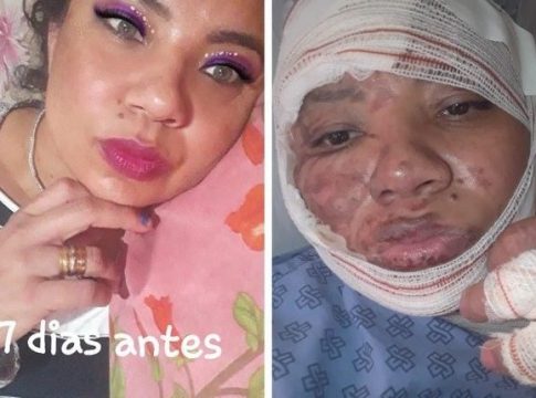 Chapa explode, provoca queimaduras em cantor sertanejo e mais duas pessoas em MS