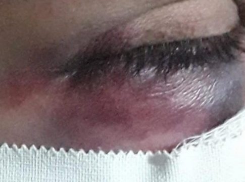 Mulher é espancada por filha até desmaiar e corre risco de perder a visão após agressões