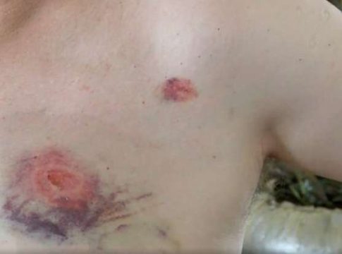 Pai leva pedradas e mordidas na hora de entregar filho para mãe no Tiradentes