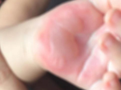 Escola de Campo Grande denunciada por maus-tratos já foi condenada após bebê ter mãos queimadas