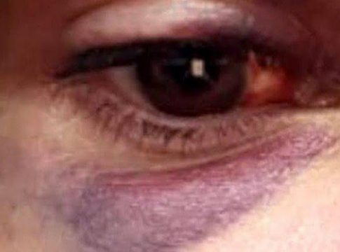 Mulher invade apartamento do ex e espanca atual namorada dele em Campo Grande
