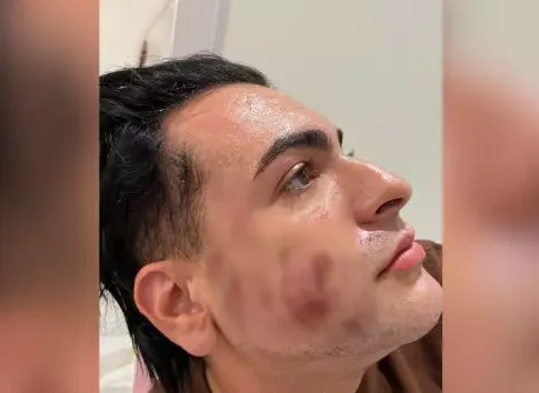 Homem morre em clínica de SP após pagar R$ 4.500 por ‘peeling de fenol’