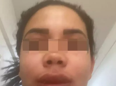 “Biomédica” que prometia bocão aplicou silicone e óleo, aponta laudo