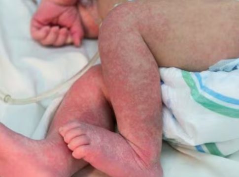 Em 24h, Dourados tem 60 novos casos confirmados de chikungunya